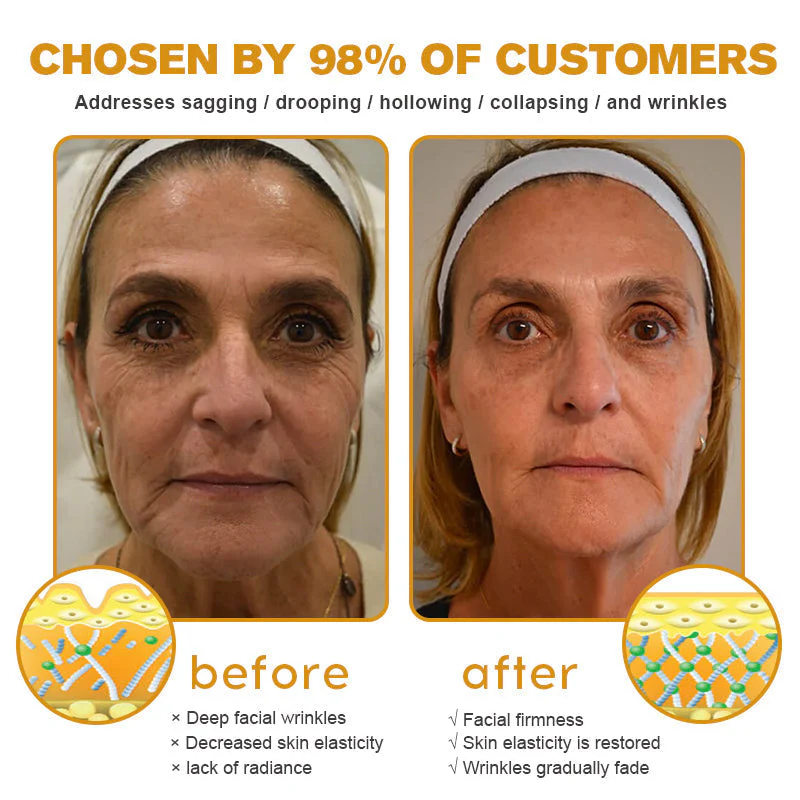 👨‍⚕️ Botox Bee Venom Wrinkle Removal Cream- LAST DAY 70% OFF✅