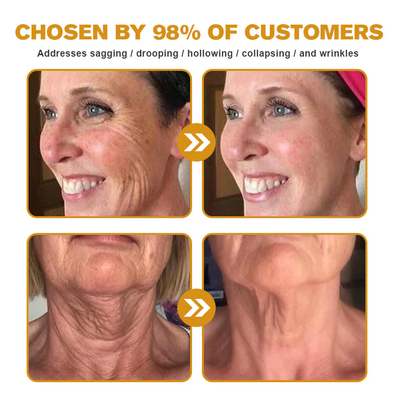 👨‍⚕️ Botox Bee Venom Wrinkle Removal Cream- LAST DAY 70% OFF✅